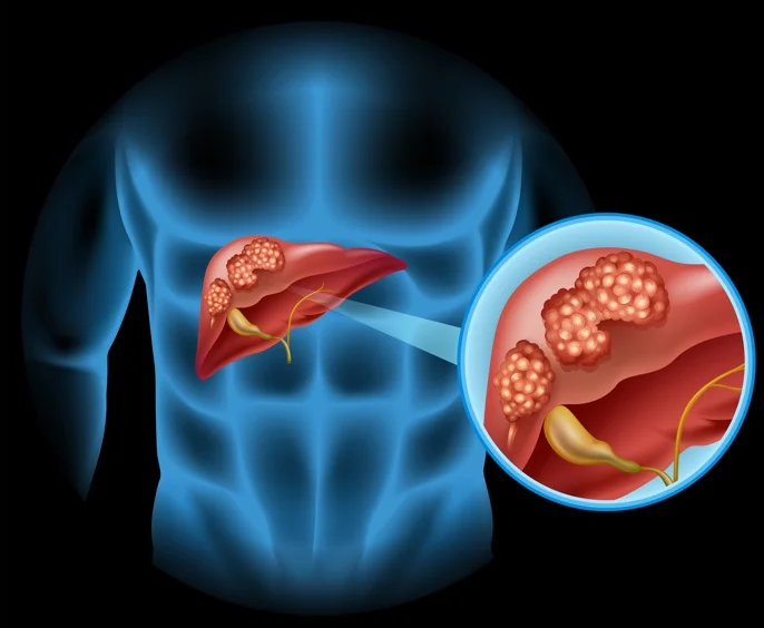 Illustration of liver with cancerous tumors highlighting stage 4 liver cancer.